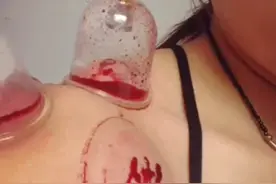 拔血罐对身体好，对于上火的人帮助挺大的图片