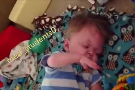 尖头并指综合征