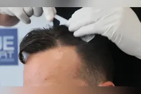 这样的秃顶还有救！国外中年大叔植发3600毛囊单位后秒变小年轻！视频封面