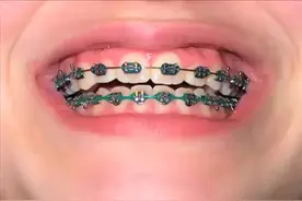 成人牙齿矫正牙齿变化过程实录