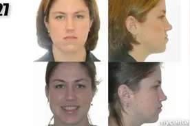 牙齿矫正前和牙齿矫正后的脸型对比，差别非常明显