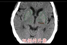 脑卒中之基底节腔隙性脑梗塞，老年人常见，基底节解剖-全是干货