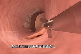 内镜医生绝技之: 内镜经黏膜下隧道肿瘤切除术(STER)视频封面