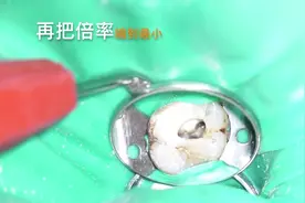 显微镜放大100倍观察蛀牙！针管治疗！看完你还不好好刷牙！