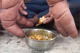 12岁男孩拥有世界上最大的手，足足有30厘米，日常都需要照料