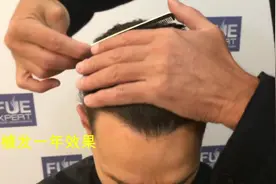 男人四十一枝花，看中年秃顶大叔植发后如何变身时尚魅力达人视频封面