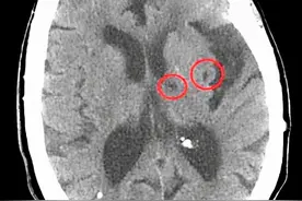 发现大脑有病可以不用治？医生坦言：4种脑病别被骗，不花冤枉钱图片