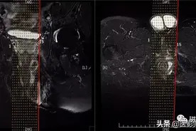 磁共振直肠MRI及肛周MRI扫描技术图片