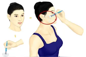 近期想要孩子？重度痤疮？这些痘痘患者可以尝试光动力疗法图片