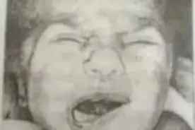 注意！孩子歪嘴哭，不是委屈，也不是面瘫，而是罕见病：歪嘴哭面容图片