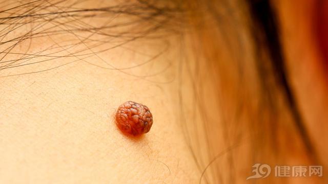 皮肤出现小红点不痛不痒