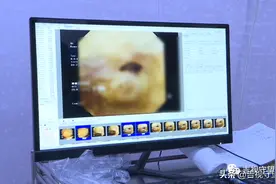 四岁娃“掏耳屎”乱动，竟致鼓膜穿孔…图片