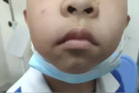八岁女孩腺样体肥大70%，医生说不手术，为什么出现腺样体面容图片