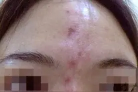 远离这6种“不明”注射物，可能分分钟让你毁容图片