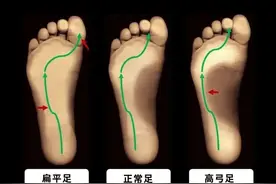 什么是高弓足？高弓足的症状和危害有哪些？图片