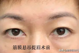 作为一个做过提眉手术的人，来说说我的术后感受图片
