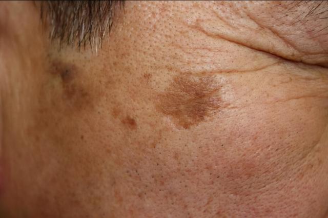 怎样去除角化癍