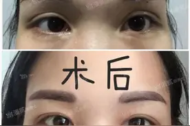 自体脂肪填充眼窝可怕吗？失败了结块会怎样？眼皮会凹凸不平吗？图片