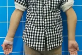 肘内翻——上肢骨折的并发症图片