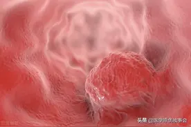 直肠癌根本不用治，治好的都是误诊了？肿瘤院长讲了四个真相图片