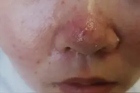 玫瑰痤疮、寻常痤疮和酒渣鼻，傻傻分不清图片