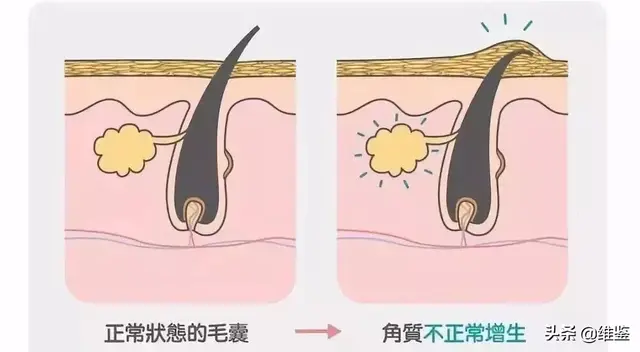 武汉皮肤科汗孔角化