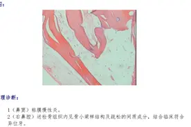 鼻子里竟然长出了牙齿，还足足有3厘米长......图片