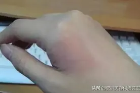 烫伤后的第一反应——冲水？涂牙膏？正确处理方式你知道吗图片