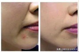 祛除“法令纹”哪些方法有用、哪些是无用功？听专业医生细说图片