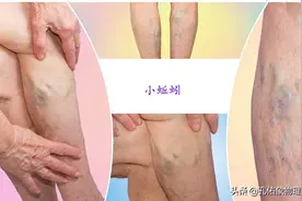 腿上盘踞的血管像“小蚯蚓”一样，是啥病？本文告知您治疗及预防图片