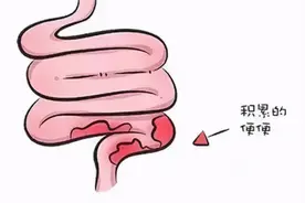 便秘不可怕，可怕的是习惯性便秘！图片