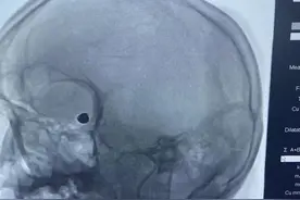 【医疗案例】视物重影源于动脉瘤 支架辅助弹簧圈栓塞术救命图片