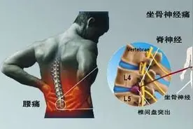 腰椎间盘突出症患者自我康复锻炼的秘方图片