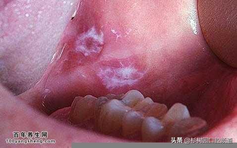 口腔白色角化病表面粗糙