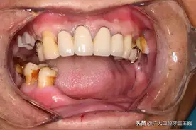 活动假牙多久换一次？需要注意什么？专家给出指导意见图片