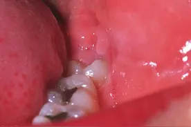 牙龈反复发炎、肿痛要警惕！可能是得了这种病图片