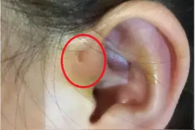听说耳朵长“聪明孔”，大富大贵还聪明？现实是，10岁女孩因它挨了刀图片