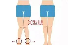 腿型矫正系列——超模腿型养成记，X腿改善就用这招图片