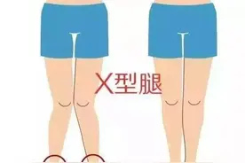 腿型矫正系列——超模腿型养成记，X腿改善就用这招图片
