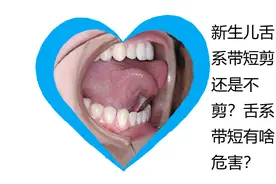新生儿舌系带剪还是不剪？舌系带短有啥危害？图片