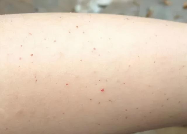 满身都是小红点