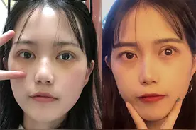 整形后悔不已的案例：你梦寐以求的大眼睛，对她们来说是一大困扰图片