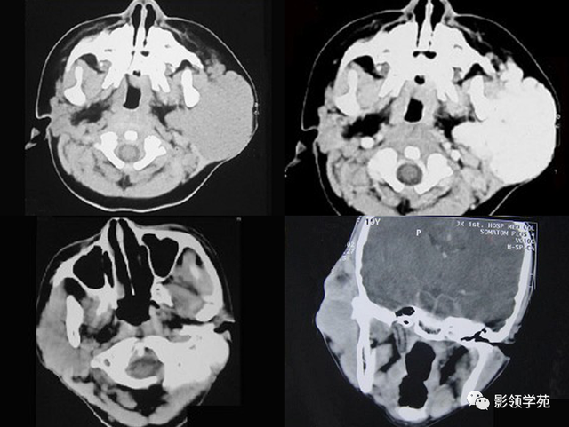 腮腺角化型鳞癌