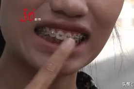 牙套戴了八个月，嘴都磨破了皮，医生却不见了图片