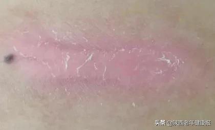 汗孔角化专用 汗孔角化专用