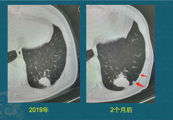 肺癌病理非角化型鳞癌