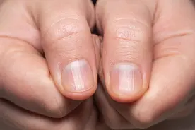 指甲变脆，出现竖纹，4种隐秘的迹象，都指向骨质疏松图片