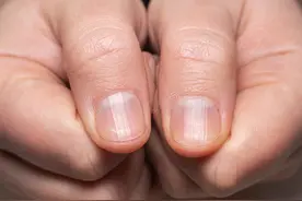 指甲变脆，出现竖纹，4种隐秘的迹象，都指向骨质疏松图片