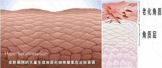 去粉刺毛囊炎痤疮鸡皮身体乳