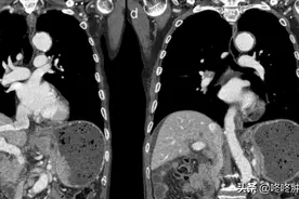 80岁的大爷运气好到“逆天”，未经治疗肿瘤完全消失了图片